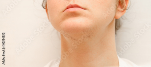 Banner is a woman with hair on her chin. Hair removal on the face.Violation of the thyroid gland. Genetic abnormalities in the work of hormones.