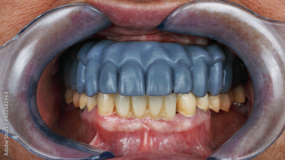 Obraz premium dental wax up blue upper jaw for diagnosis in bite