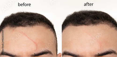 Fototapeta Comparison of Before and after scar revision (treatment ) using laser , led and