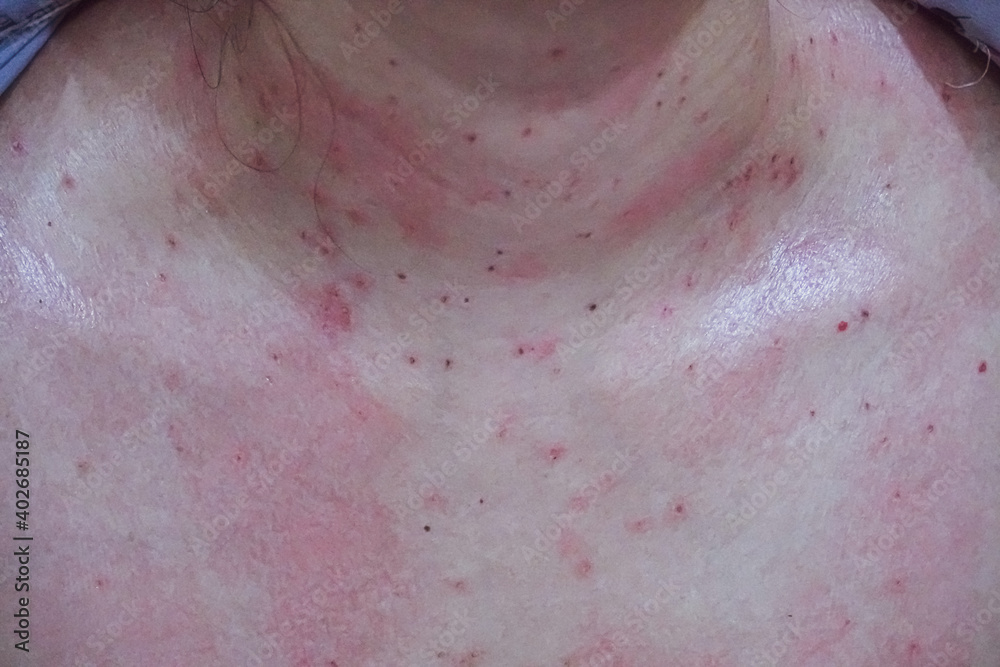 Fototapeta premium close up of skin of women after laser removal wrinkles.