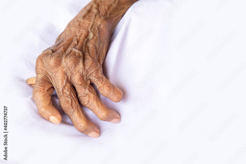 The hands of an old woman with rheumatoid arthritis. Diseases caused by degeneration of the joints of the fingers.