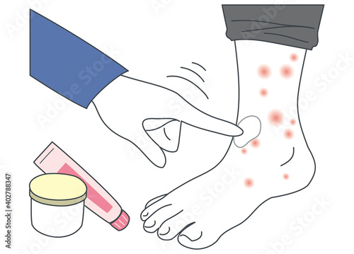 塗り薬で湿疹・アトピー・蕁麻疹を治療する足のイラスト