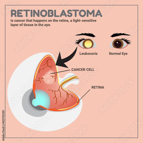 Medical illustration of Retinoblastoma, eye cancer