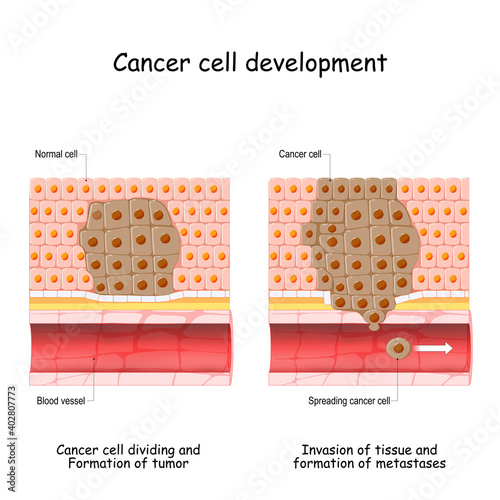 Cancer cell development. Tumor Formation