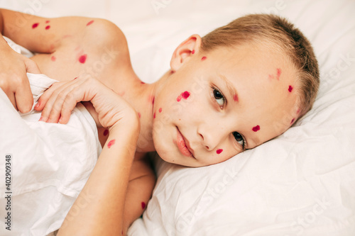 A small child with varicella virus lies in bed and looks at the camera. Varicella zoster virus. Place for text. Banner. Chickenpox concept. Medicine. Medical concept. Close up. Layout. photo