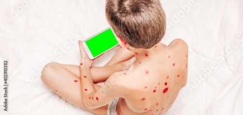 A small child with a chicken virus sits on the bed and plays on the phone. Varicella virus. A place for text. Banner. Chicken pox concept. Medicine. Medical concept. Close up. Mock up. photo