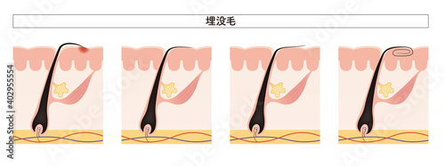 Cross section of the skin 25 front
