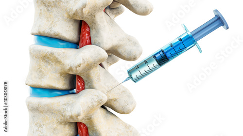 Facet joint injection, therapy against backbone injury or pain. Close-up of vertebrae with a syringe isolated on a white background 3D rendering illustration. 