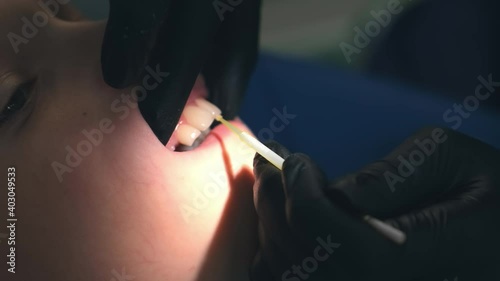 Doctor hygienist applying fluoride to teen teeth with cotton swab in dentistry. Covering using fluoride gel. Cure concept. Dentist making fluoridation child boy teeth after cleaning for protection.