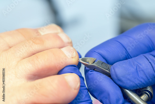 Medical pedicure procedure with nail clipper tool