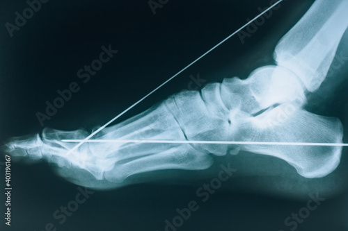 X-ray of the foot. Fracture of the bones of the foot. Bone fixation pins photo