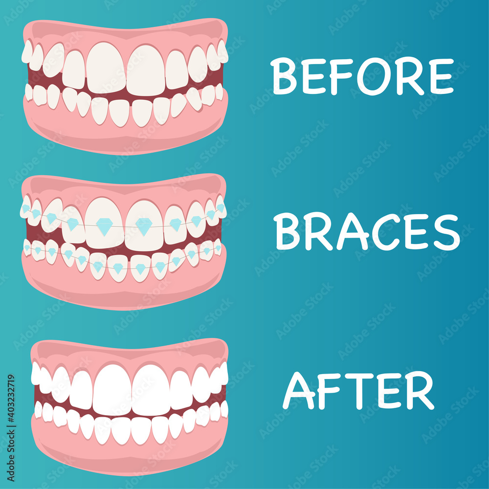 Stages of teeth alignment, before and after correction with brackets