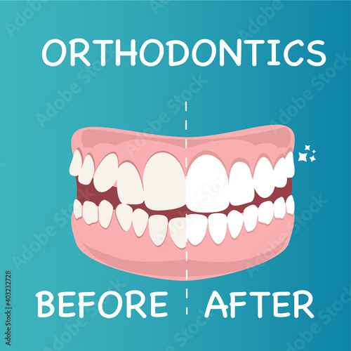 Stages of teeth alignment, before and after correction with brackets.Correction of teeth with orthodontic braces. Orthodontic dentistry. The alignment of the teeth. Healthy lifestyle and dental care
