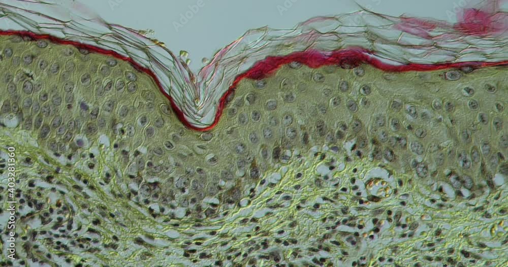Infection of the skin with Herpes zoster tissue under the microscope