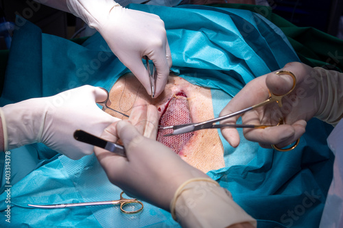 A patient has split skin transplanted on the abdomen to cover a wound