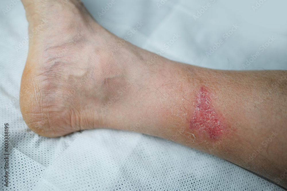 large healing wound from a severe burn on the leg of an adult male patient, redness, scarring of the skin, the concept of medical care, human tissue regeneration large healing wound from a severe burn on the leg of an adult male patient, redness, scarring of the skin, the concept of medical care, human tissue regeneration