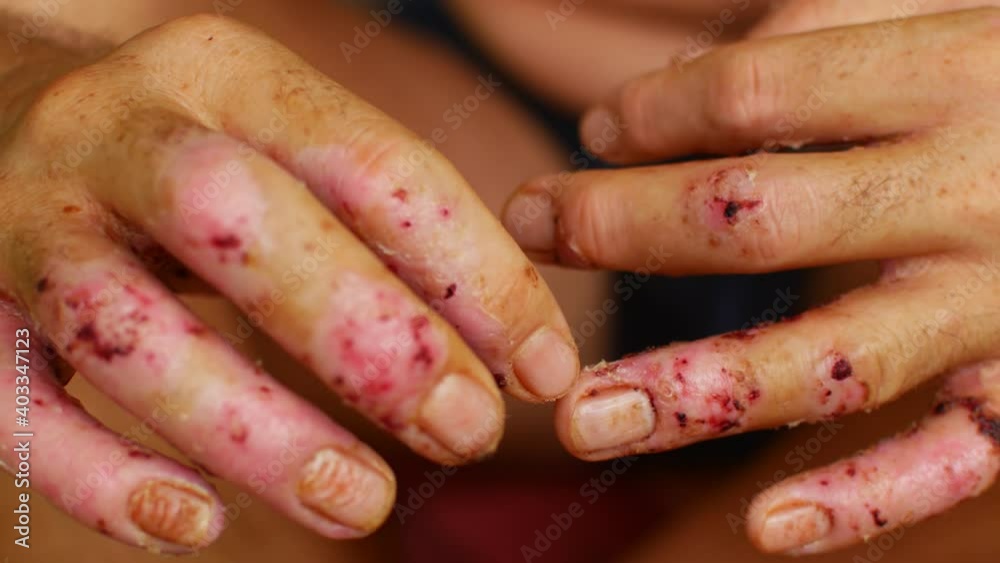 Terrible ulcers on the hands, illness Terrible ulcers on the hands, illness