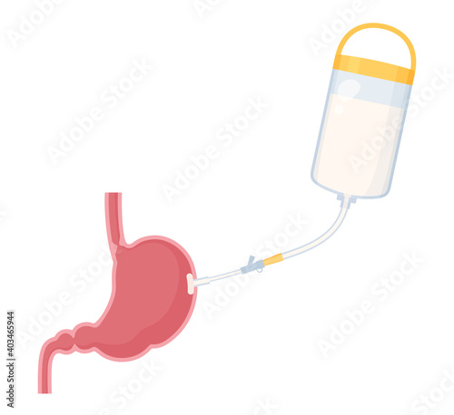 胃ろうに栄養剤を投与するイラスト_胃の断面_PEG