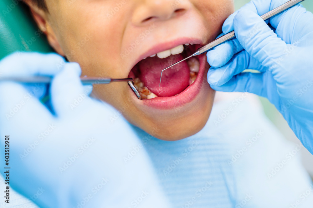 Effective solution to dental problems of teenager. Pediatric dentistry requires special attention and high competence. Tooth with caries. Bor machine effectively removes black spots on child's tooth