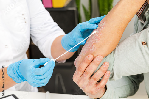 A dermatologist takes a skin analysis of a sick patient. Examination and diagnosis of skin diseases-allergies, psoriasis, eczema, dermatitis.