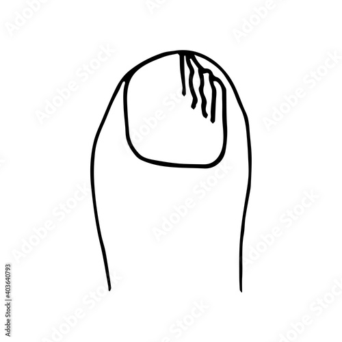Hand-drawn simple vector drawing in black outline. Fungus of the big toe, onychomycosis. Nail infection, disease, pedicure. Medicine and health.