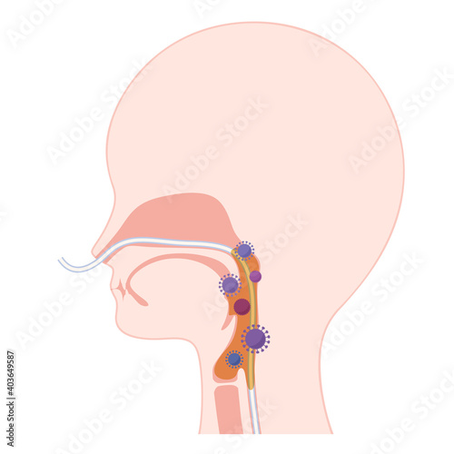 経鼻経管栄養_NGで痰と細菌が増加した咽頭のイラスト