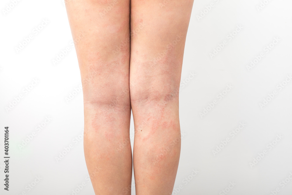Lower Leg Rashes Acute atopic dermatitis on the legs behind the knees of a child is a ...