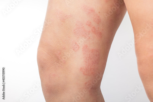 Severe atopic eczema on the legs of a child is a dermatological disease of the skin. Large, red, inflamed, scaly rash on the legs. Legs of a teenager with severe atopic dermatitis.Close-up © SNAB