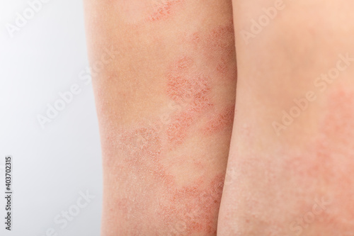 Acute atopic dermatitis on the legs behind the knees of a child is a dermatological disease of the skin. Large, red, inflamed, scaly rash on the legs. Legs of a teenager with severe atopic eczema photo