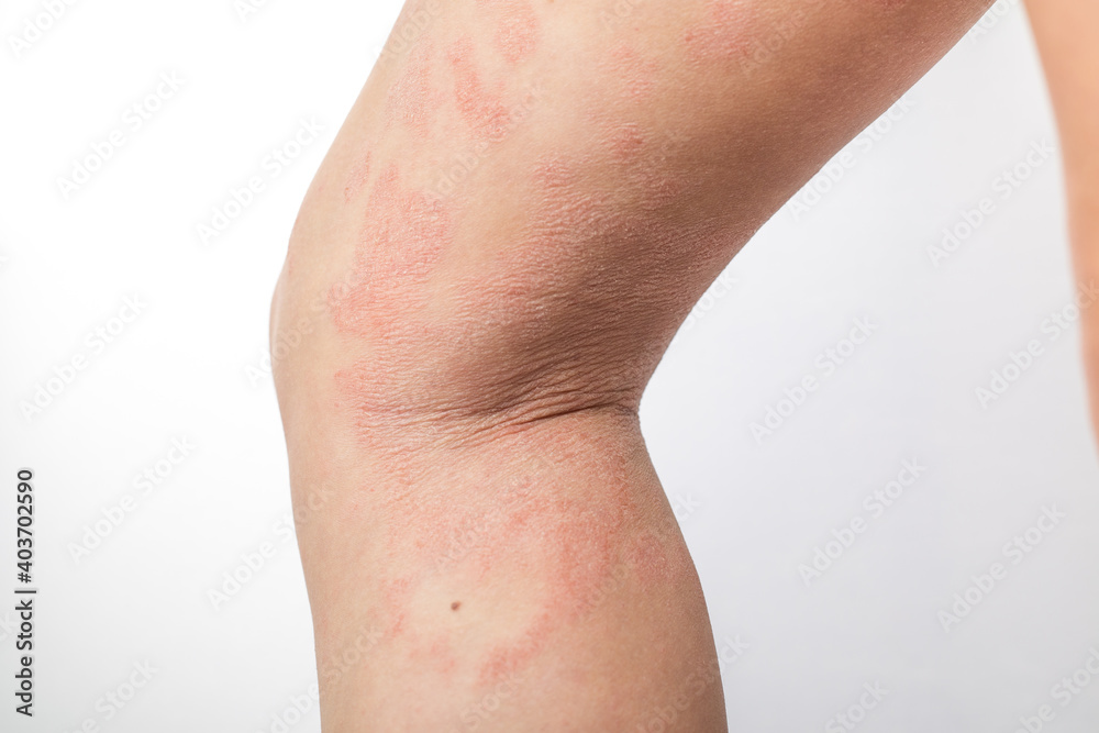 Severe atopic eczema on the legs of a child is a dermatological disease of the skin. Large, red, inflamed, scaly rash on the legs. Legs of a teenager with severe atopic dermatitis.Close-up Severe atopic eczema on the legs of a child is a dermatological disease of the skin. Large, red, inflamed, scaly rash on the legs. Legs of a teenager with severe atopic dermatitis.Close-up