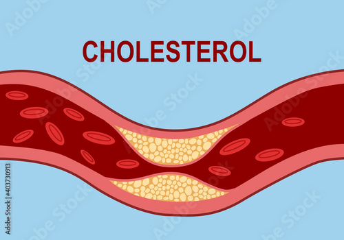Human body vein with blood cell in flat design. Artery blocked with cholesterol. High cholesterol level. 