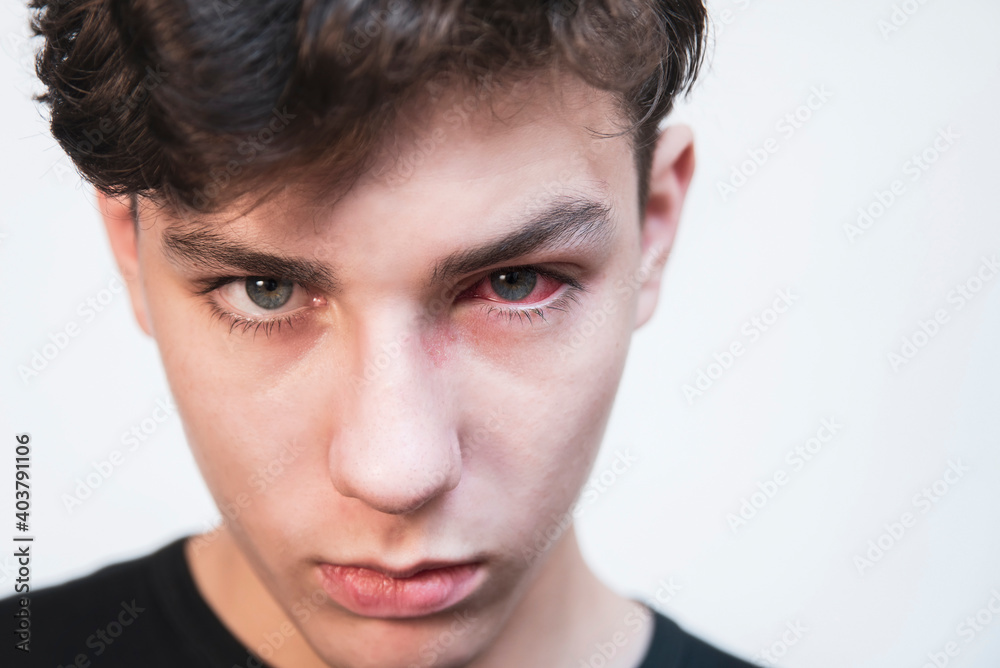 Red eyes are sick with conjunctivitis in a teenage boy, the boy is sad and suffers from pain, and can not learn and read until the eyes recover. Copy space