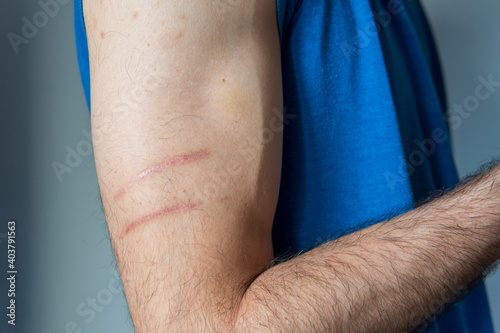 Man's athlete arm with two long healing scars from scratches. Wounds on the skin caused by sport activity. Healthcare and sport concept