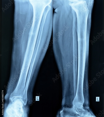 fracture tibia. small tibial fracture. © Sanja