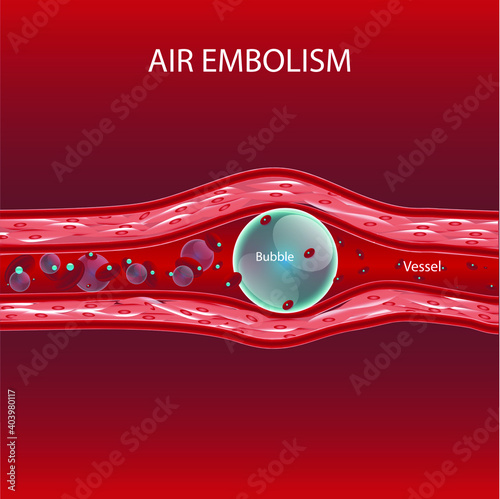 air bubble in vessel cause of decompression illness treatment by hyperbaric chamber