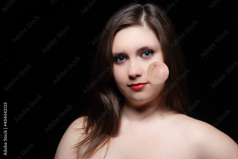 Woman skincare concept. Collage portrait of young woman before and after acne removing Woman skincare concept. Collage portrait of young woman before and after acne removing