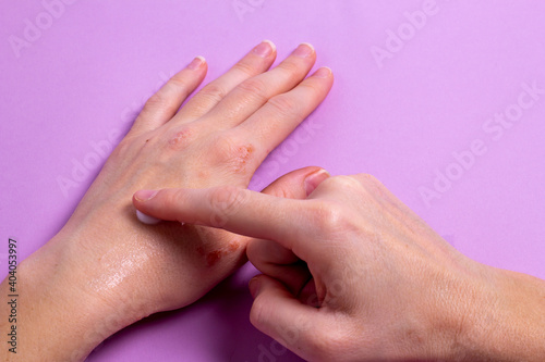Women s hands with eczema apply the cream to the damaged skin of the hands. Treatment of dermatitis and eczema. Problems with the skin of the hands.