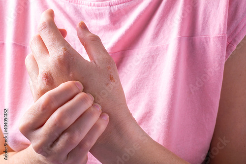 Close-up of a woman's hands itching. dermatitis or eczema on the hands. Allergic skin with red spots.