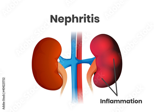 nephritis