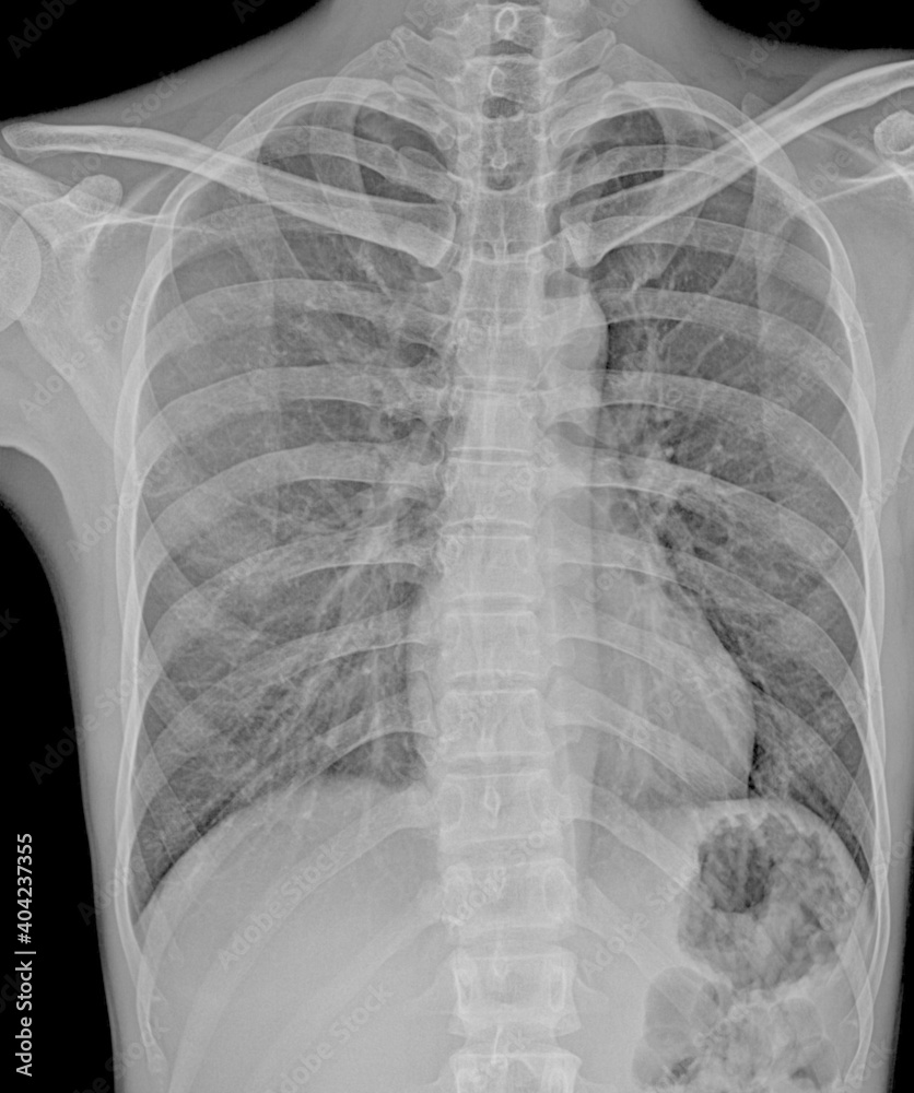 lung x-ray Pneumothorax Stock Photo | Adobe Stock