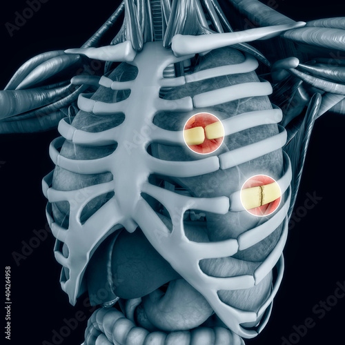 Anatomy and the human body. Costochondral separation, separated rib. Broken, fractured ribs. Bones in the rib cage breaks or cracks. The chest hurt more with deep breath. Perforated lung. 3d render
