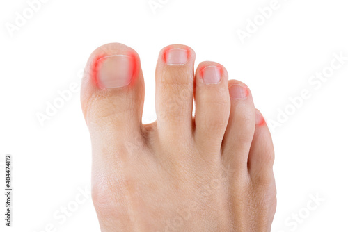 Ingrown toenails on a woman's foot, isolated on white background, pain in the big toe