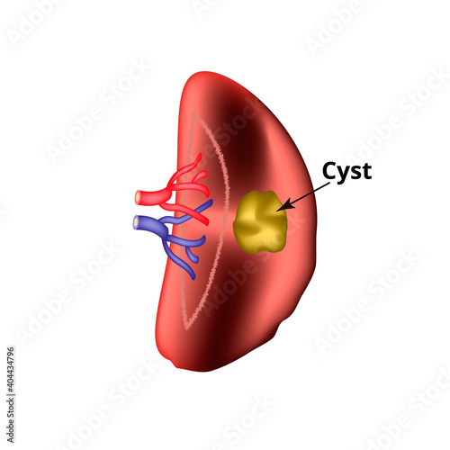 Anatomical structure of the spleen. Spleen cyst. Vector illustration on isolated background