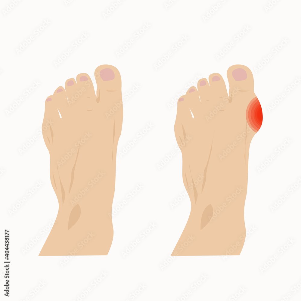 Hallux valgus of the thumb after injury or other factors Hallux valgus of the thumb after injury or other factors
