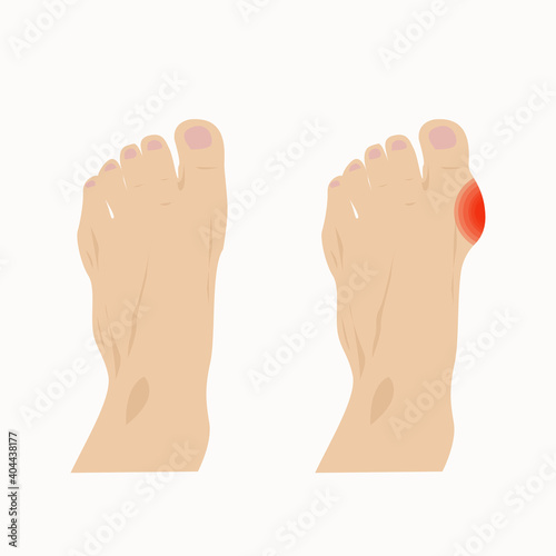 Hallux valgus of the thumb after injury or other factors