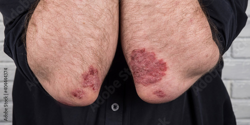 Psoriasis. Autoimmune genetic disease. A man with sore hands, dry flaky skin on his arm with psoriasis vulgaris, eczema. A large, red, inflamed, scaly rash on the elbows, a dermatological skin disorde photo