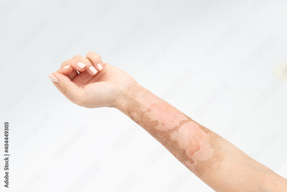 Thermal burn on the hand, skin peeling Thermal burn on the hand, skin peeling