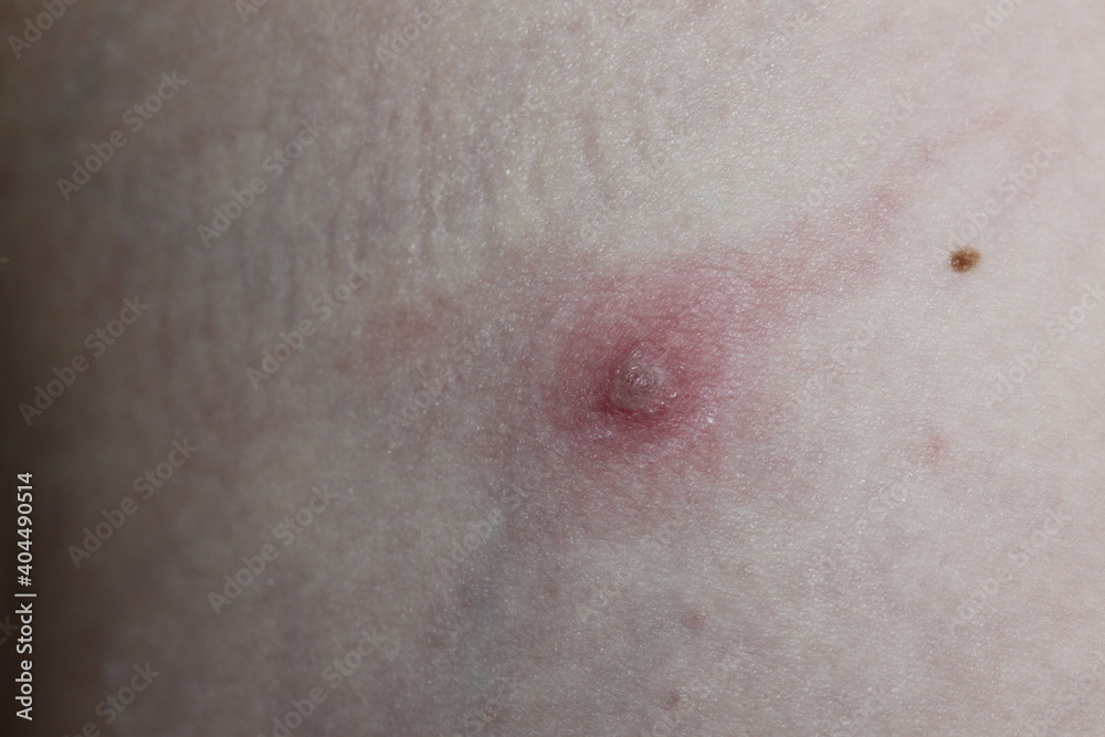 Fototapeta premium chickenpox close up