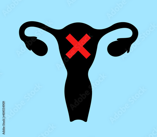 Uterus and womb is crossed out - abortion and termination of pregnancy, miscarriage and death of foetus and fetus, infertile human organ out of order. Vector illustration.