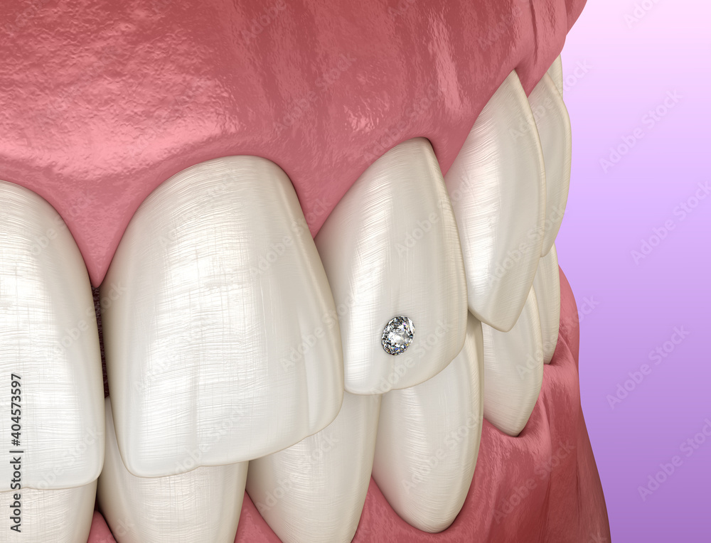 Tooth piercing by diamond, 3D illustration concept. Tooth piercing by diamond, 3D illustration concept.